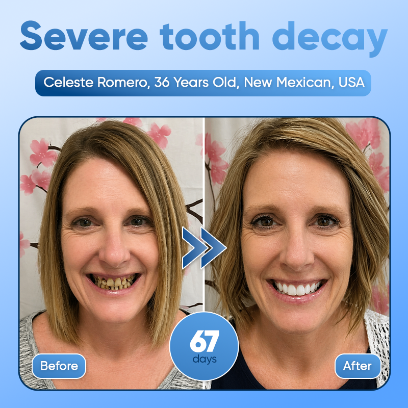 Your Smile😁Tideglusib Fast‑Dissolving Tooth & Gum Repair Oral Strips🦷✨ (𝟓-𝐢𝐧-𝟏 💎 𝐑𝐞𝐛𝐮𝐢𝐥𝐝 𝐄𝐧𝐚𝐦𝐞𝐥 & 𝐃𝐞𝐧𝐭𝐢𝐧 • 𝐒𝐭𝐫𝐞𝐧𝐠𝐭𝐡𝐞𝐧 𝐆𝐮𝐦𝐬 • 𝐄𝐫𝐚𝐝𝐢𝐜𝐚𝐭𝐞 𝐓𝐚𝐫𝐭𝐚𝐫 & 𝐎𝐝𝐨𝐫 • 𝐖𝐡𝐢𝐭𝐞𝐧𝐢𝐧𝐠 • 𝐒𝐭𝐨𝐩 𝐓𝐨𝐨𝐭𝐡 𝐒𝐞𝐧𝐬𝐢𝐭𝐢𝐯𝐢𝐭𝐲)