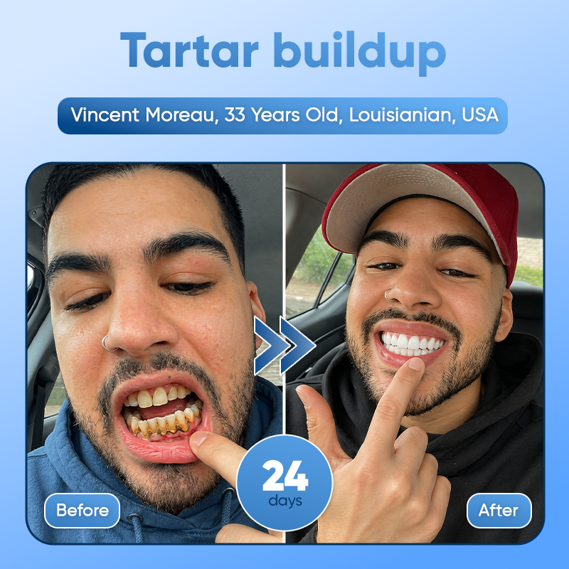 Your Smile😁Tideglusib Fast‑Dissolving Tooth & Gum Repair Oral Strips🦷✨ (𝟓-𝐢𝐧-𝟏 💎 𝐑𝐞𝐛𝐮𝐢𝐥𝐝 𝐄𝐧𝐚𝐦𝐞𝐥 & 𝐃𝐞𝐧𝐭𝐢𝐧 • 𝐒𝐭𝐫𝐞𝐧𝐠𝐭𝐡𝐞𝐧 𝐆𝐮𝐦𝐬 • 𝐄𝐫𝐚𝐝𝐢𝐜𝐚𝐭𝐞 𝐓𝐚𝐫𝐭𝐚𝐫 & 𝐎𝐝𝐨𝐫 • 𝐖𝐡𝐢𝐭𝐞𝐧𝐢𝐧𝐠 • 𝐒𝐭𝐨𝐩 𝐓𝐨𝐨𝐭𝐡 𝐒𝐞𝐧𝐬𝐢𝐭𝐢𝐯𝐢𝐭𝐲)