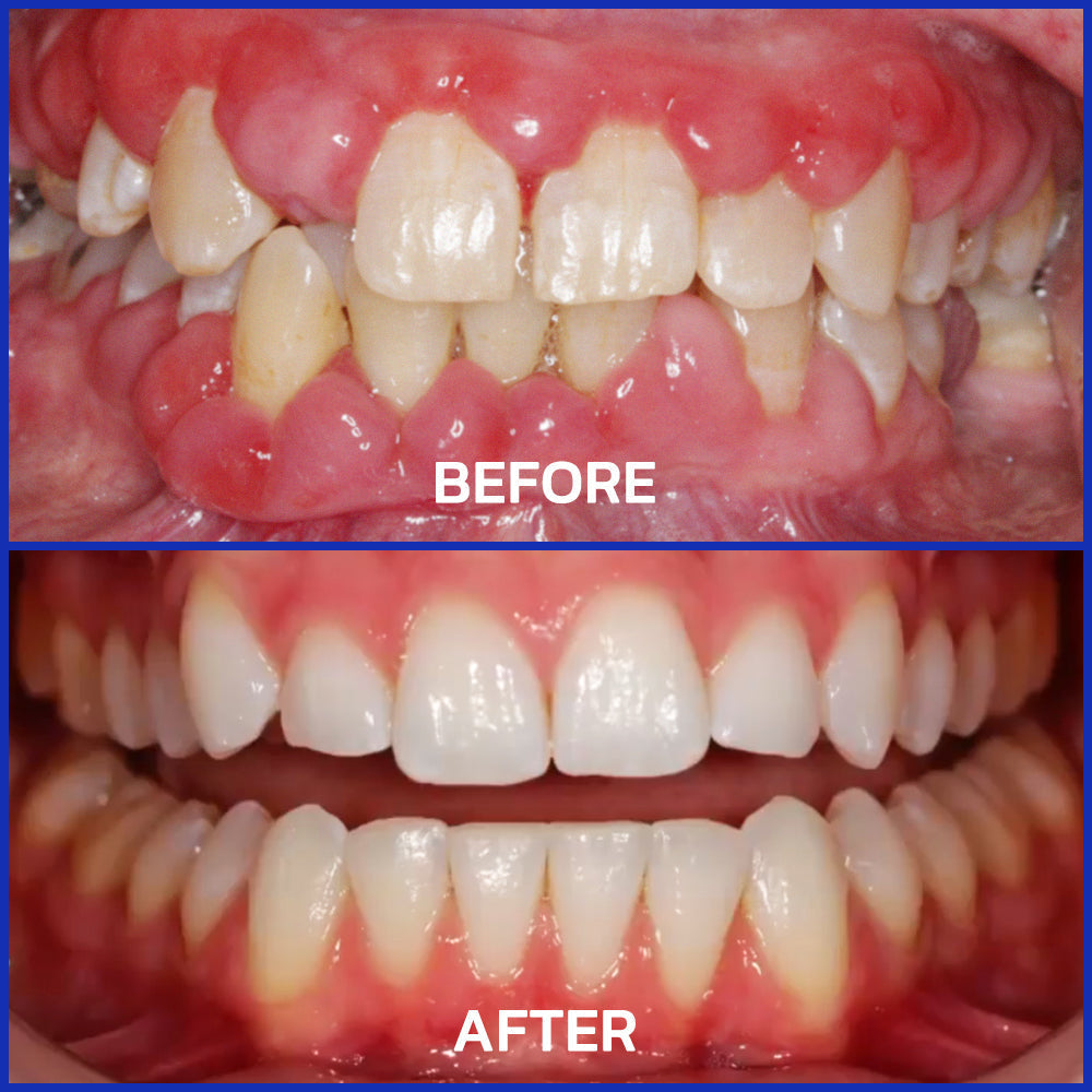 ⭐️Furzero® Focussmile bee venom treatment powder for oral use🦷