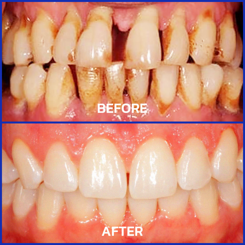⭐️Furzero® Focussmile bee venom treatment powder for oral use🦷